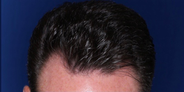 52 year old male 8 months following 2000 grafts to restore frontal temporal hair loss