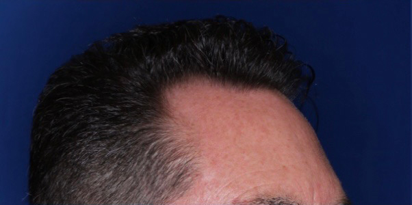 52 year old male 8 months following 2000 grafts to restore frontal temporal hair loss