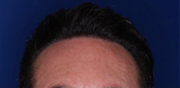 52 year old male 8 months following 2000 grafts to restore frontal temporal hair loss