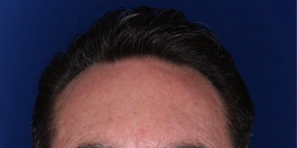 52 year old male 8 months following 2000 grafts to restore frontal temporal hair loss