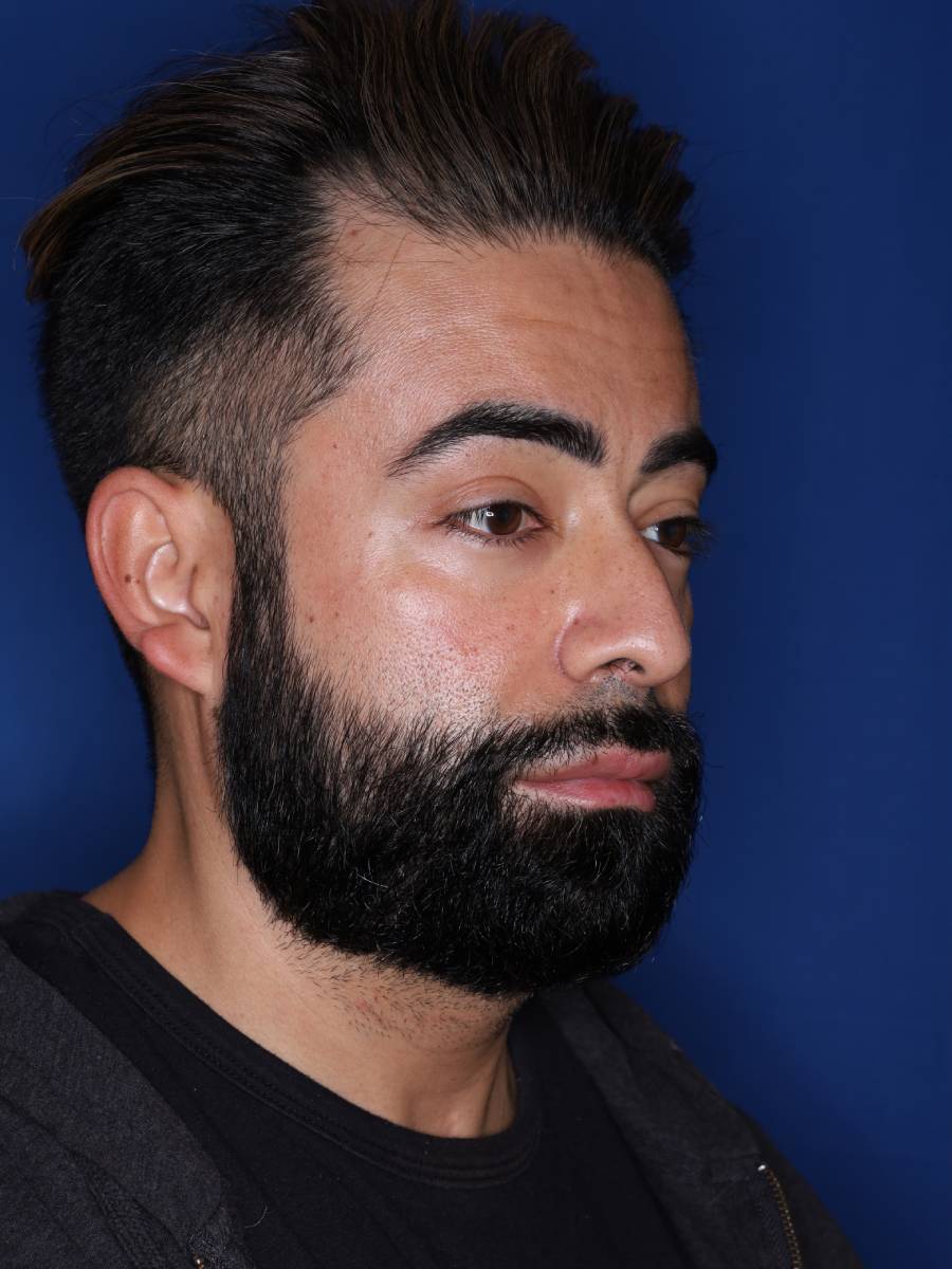 39 year old male one year following 1500 grafts to frontal temporal hair line