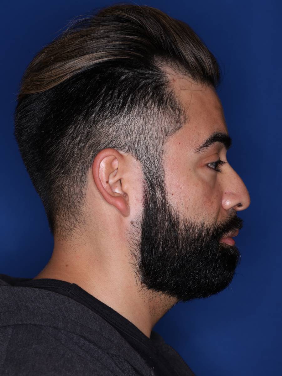 39 year old male one year following 1500 grafts to frontal temporal hair line