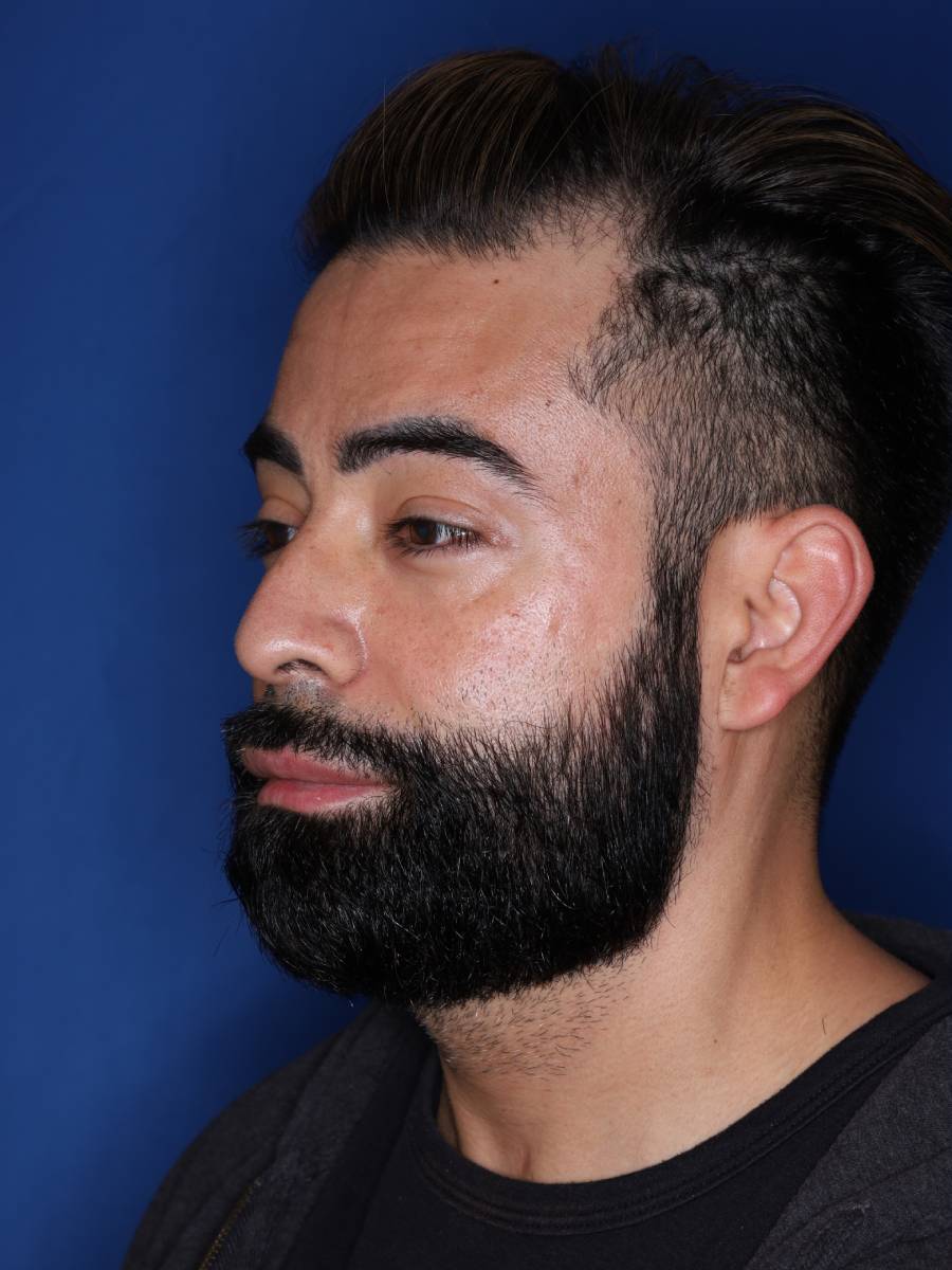 39 year old male one year following 1500 grafts to frontal temporal hair line
