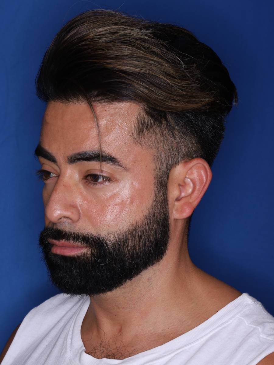 39 year old male one year following 1500 grafts to frontal temporal hair line