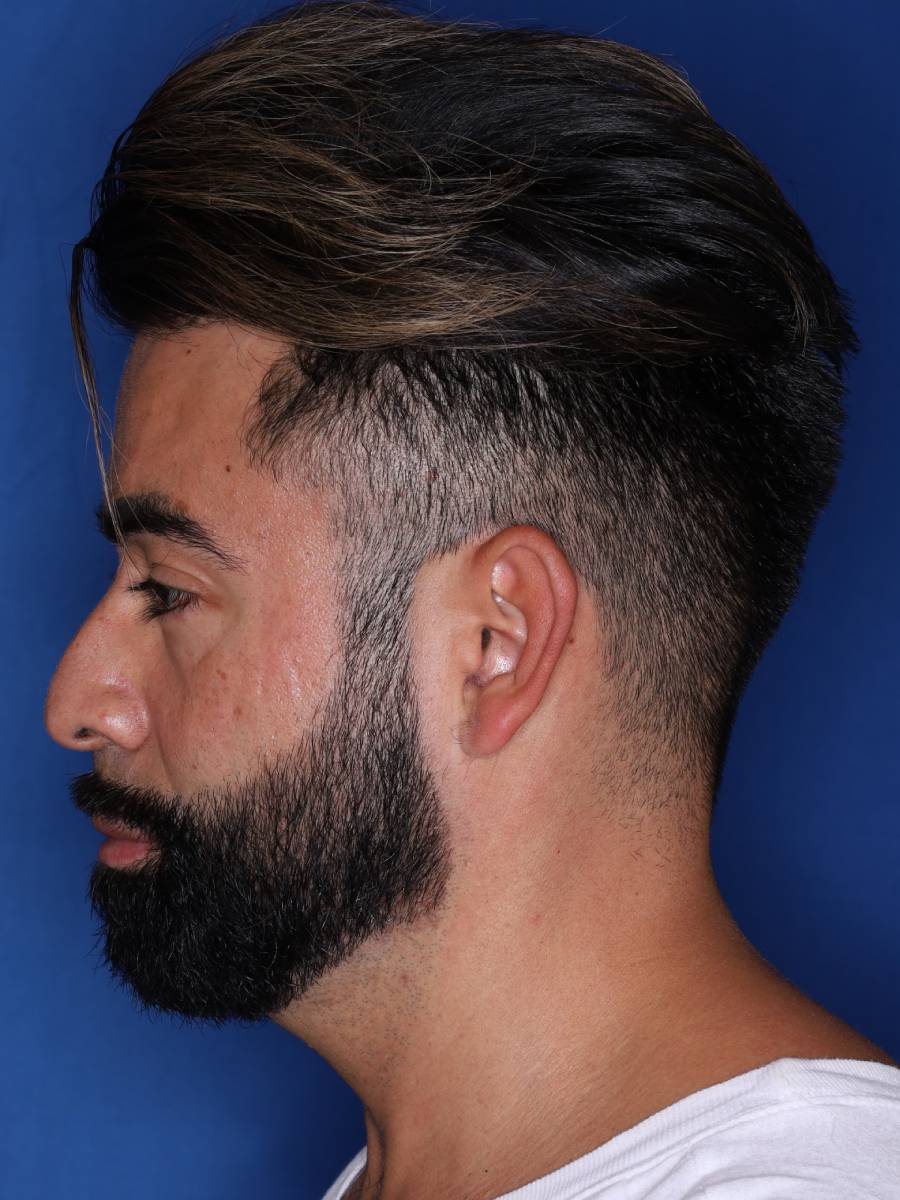 39 year old male one year following 1500 grafts to frontal temporal hair line
