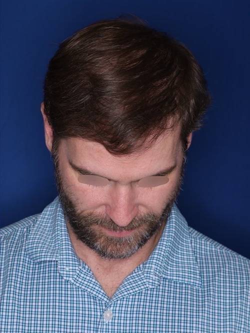 42 year old patient 12 months following 2,500 grafts to restore frontal hairline and mid-scalp