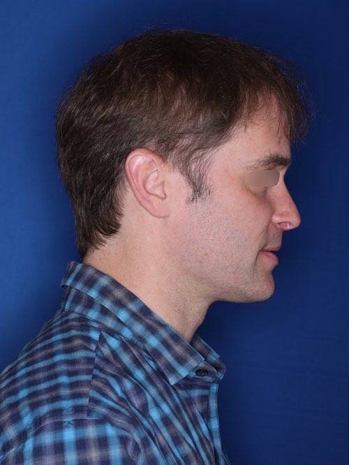 42 year old patient 12 months following 2,500 grafts to restore frontal hairline and mid-scalp