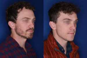 33 yrs old male patient 1+ year post op 2,000 graphs to restore frontal hairline & mid scalp