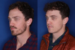 33 yrs old male patient 1+ year post op 2,000 graphs to restore frontal hairline & mid scalp