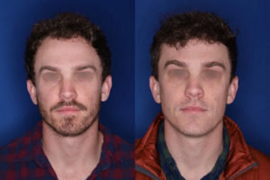 33 yrs old male patient 1+ year post op 2,000 graphs to restore frontal hairline & mid scalp