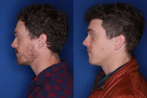 33 yrs old male patient 1+ year post op 2,000 graphs to restore frontal hairline & mid scalp