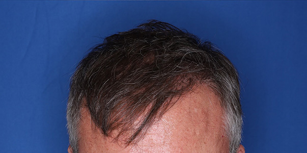 after hair transplant