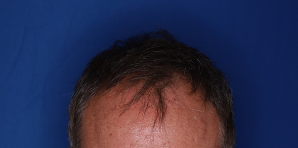 before hair transplant