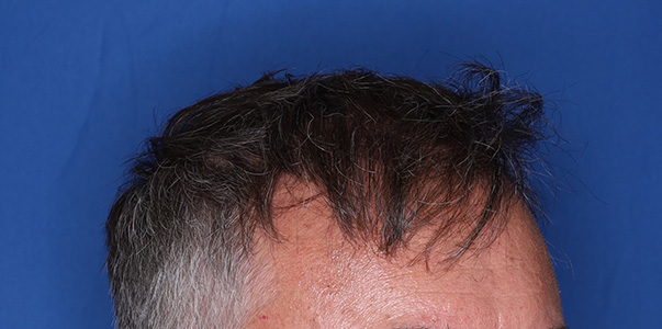 after hair transplant