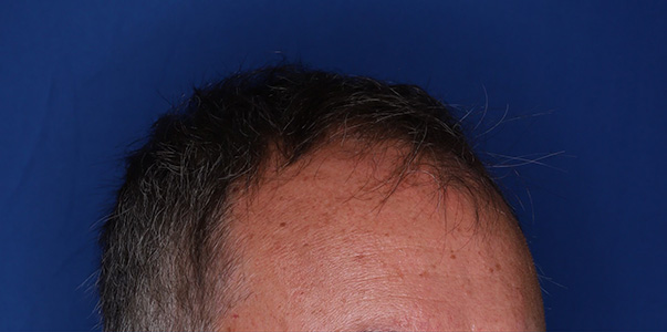 before hair transplant