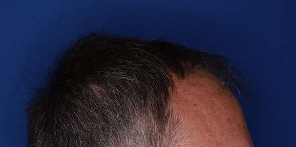 before hair transplant