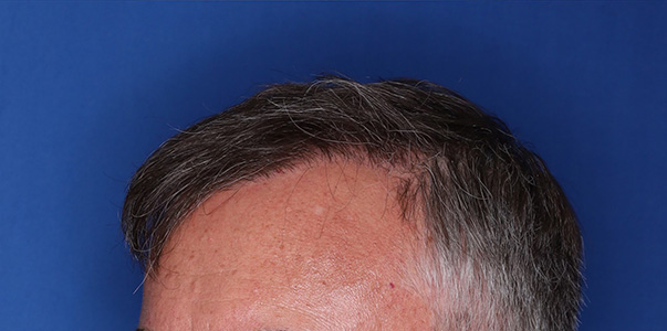 after hair transplant