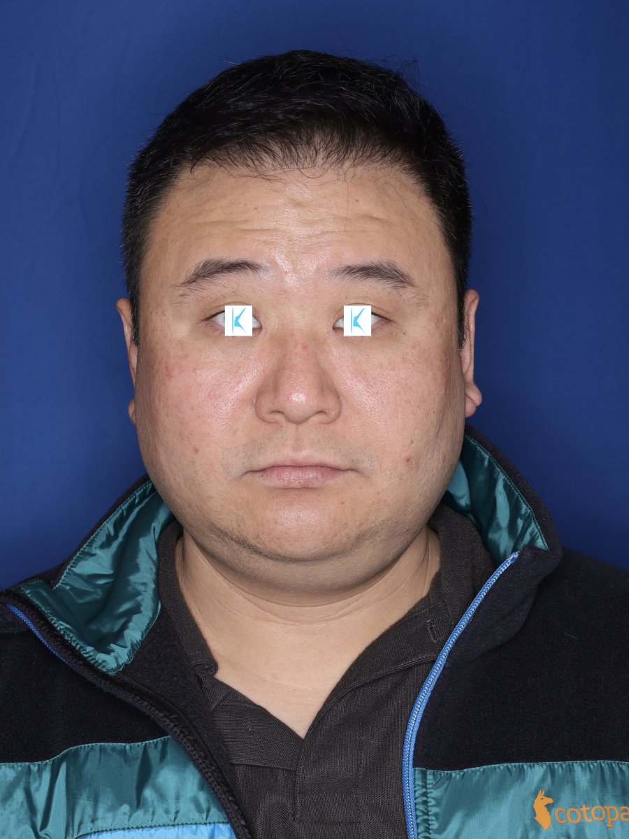 after hair transplant