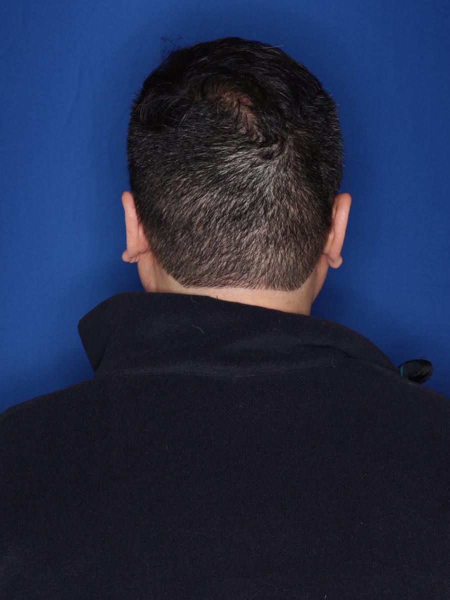 after hair transplant