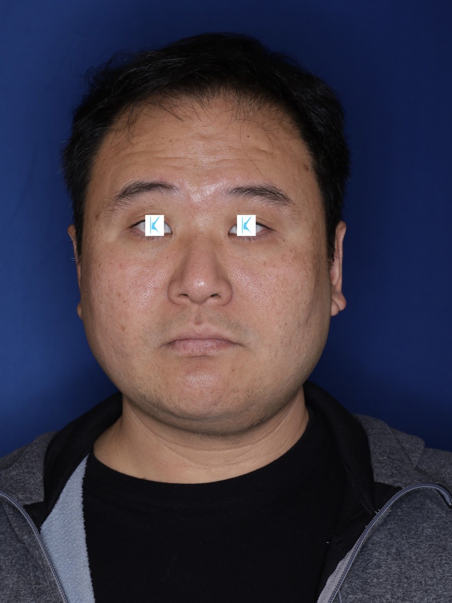 before hair transplant