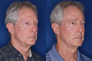 67 year old male 7 months following full eyebrow transplant.