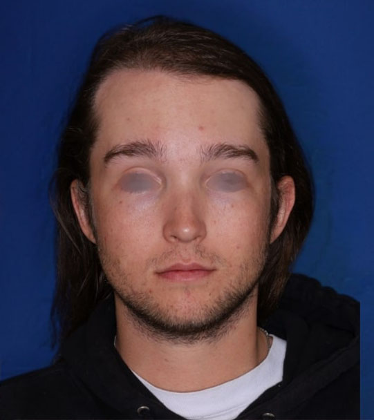 25 year old male about 2 years following 1,500 graft transplant