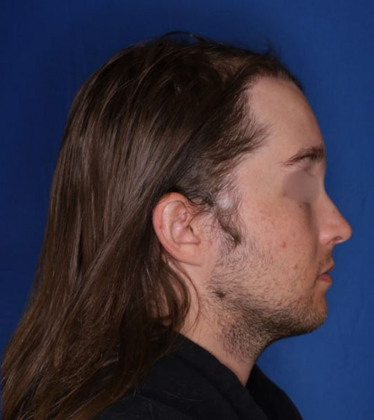 25 year old male about 2 years following 1,500 graft transplant