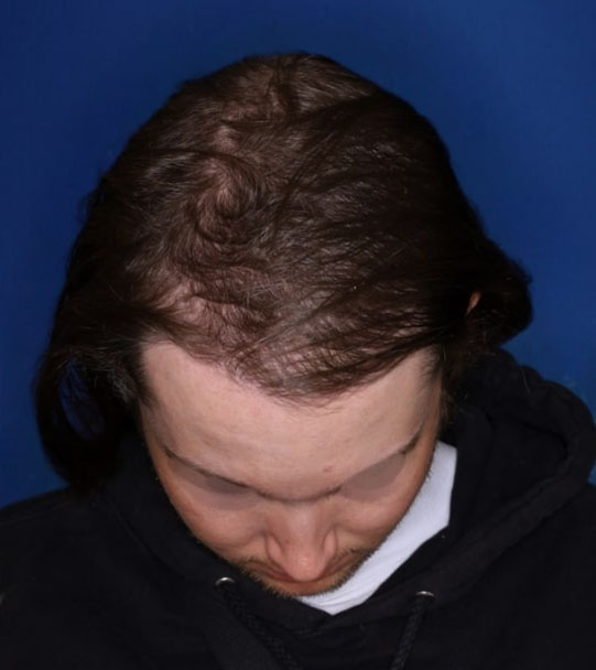 25 year old male about 2 years following 1,500 graft transplant