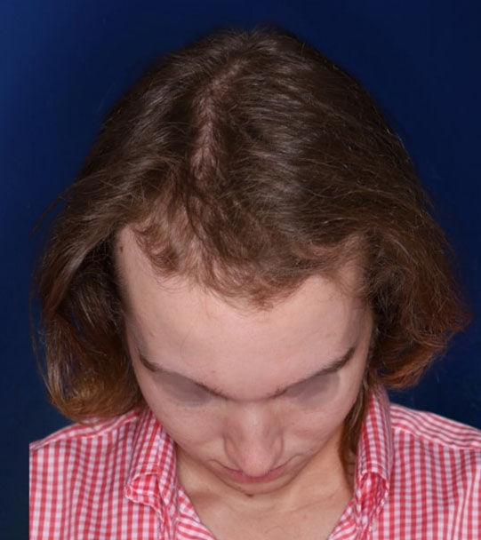 25 year old male about 2 years following 1,500 graft transplant