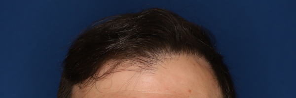 37-year-old male, 15 months after 3,000 graft hair transplant