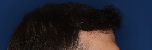 37-year-old male, 15 months after 3,000 graft hair transplant