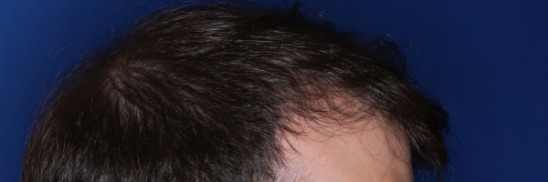 37-year-old male before 3,000 graft hair transplant