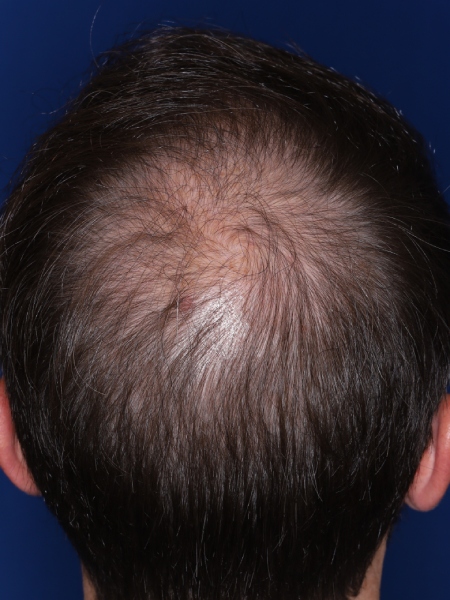 37-year-old male before 3,000 graft hair transplant