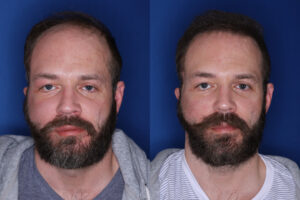 37 year old male 7 months post 2,500 graft transplant