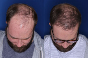 37 year old male 7 months post 2,500 graft transplant