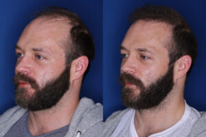 37 year old male 7 months post 2,500 graft transplant