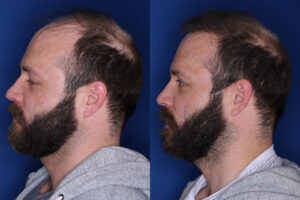 37 year old male 7 months post 2,500 graft transplant