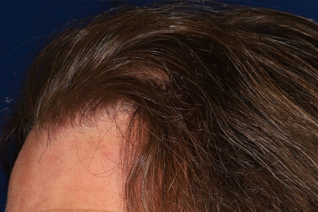 Close-up of a person's hairline and forehead, showing brown hair with some thinning near the scalp.