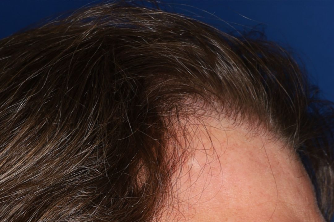 Close-up of a person's hairline and forehead, showing brown hair against a dark blue background.