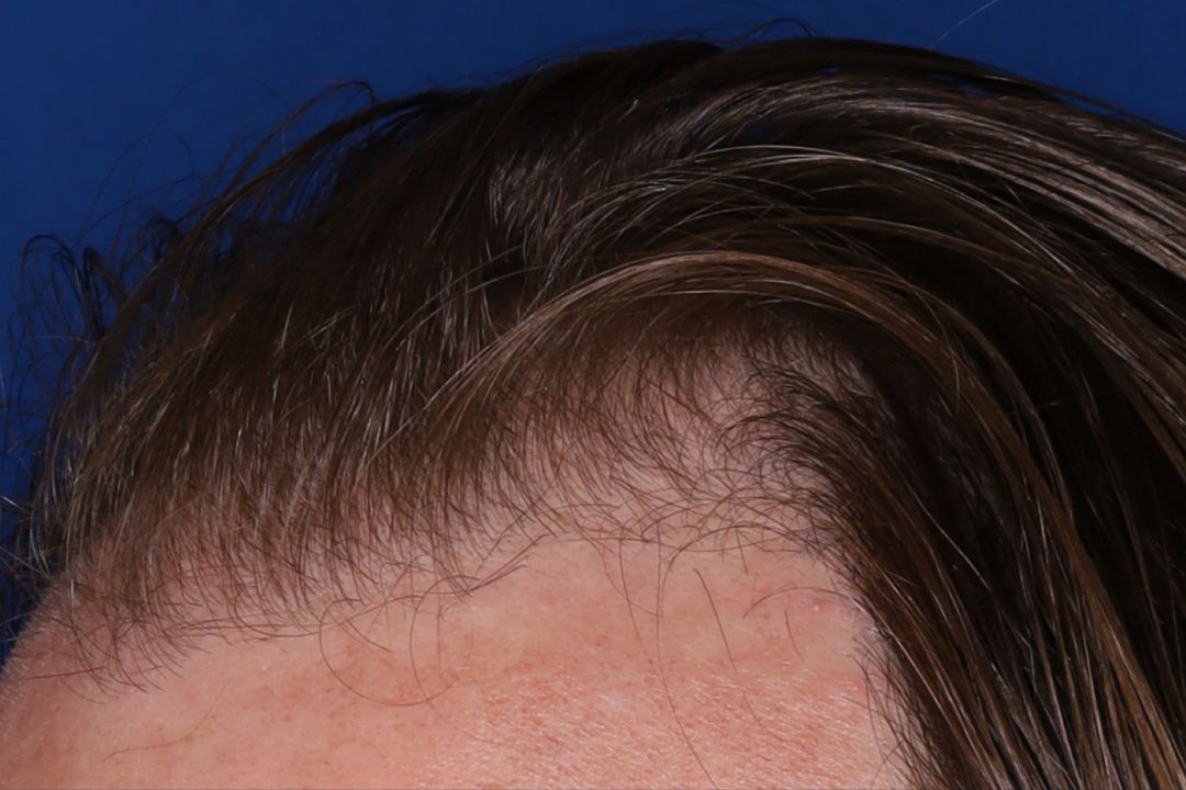 Close-up of a person's hairline and forehead against a blue background, showing fine brown hair and some thinning near the hairline.