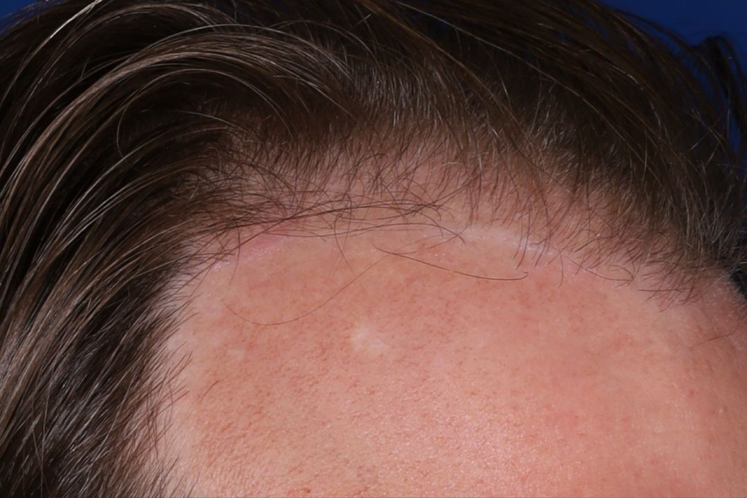Close-up of a person's forehead and hairline, showing thinning hair and early signs of hair loss at the temple area.