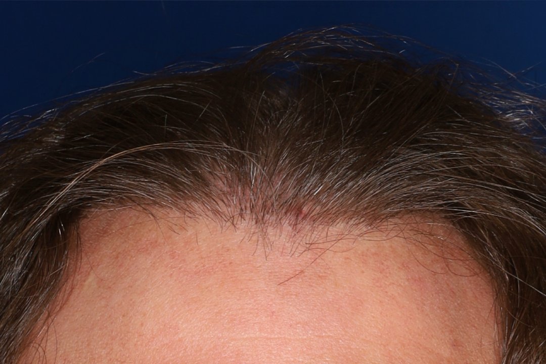 Close-up of a person's hairline and forehead with visible thinning hair against a dark blue background.