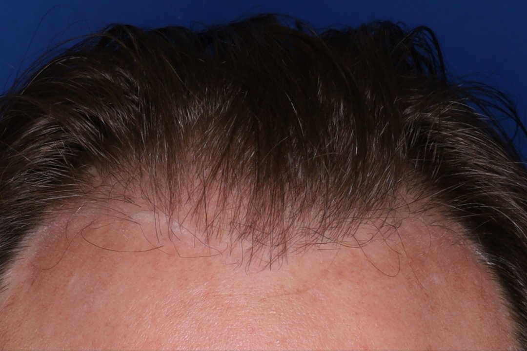 Close-up view of the front hairline and forehead of a person with dark brown hair against a blue background.
